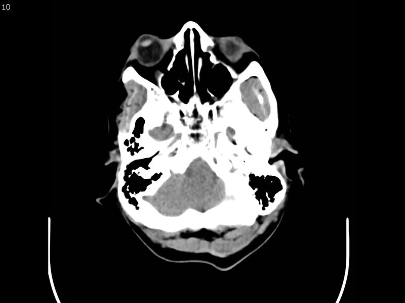 File:Atypical meningioma - intraosseous (Radiopaedia 64915-73867 A 10).jpg