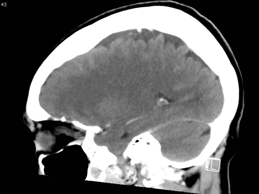 Atypical meningioma - intraosseous (Radiopaedia 64915-73867 F 42).jpg