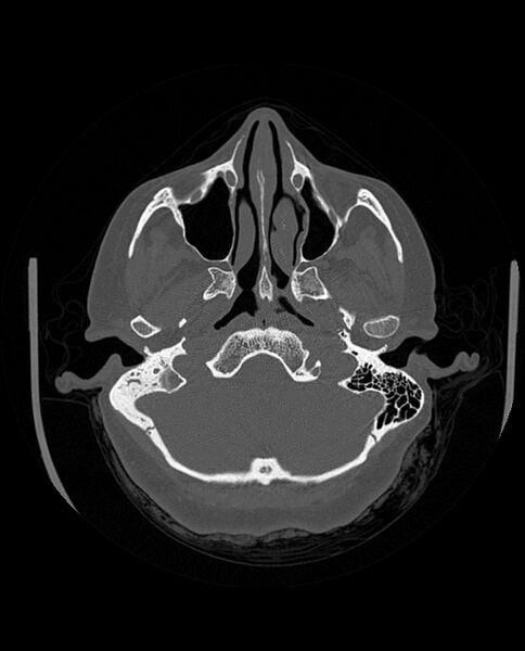File:Automastoidectomy with labyrinthine fistula (Radiopaedia 84143-99411 Axial non-contrast 70).jpg