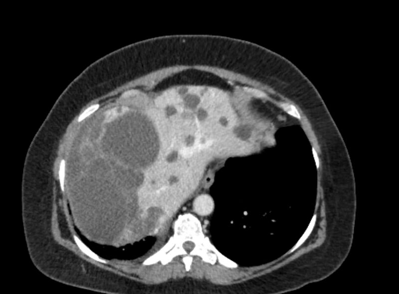 File:Autosomal dominant polycystic kidney disease (Radiopaedia 57124-64017 A 22).jpg