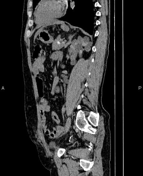 File:Autosomal dominant polycystic kidney disease (Radiopaedia 87830-104287 C 59).jpg