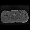 Avascular necrosis of the hip (Radiopaedia 29563-30067 Axial T1 C+ fat sat 16).jpg