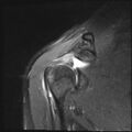 Avulsion fracture - greater tuberosity of humerus (Radiopaedia 71216-81515 Coronal PD fat sat 13).jpg