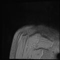 Avulsion fracture - greater tuberosity of humerus (Radiopaedia 71216-81515 Coronal T2 1).jpg