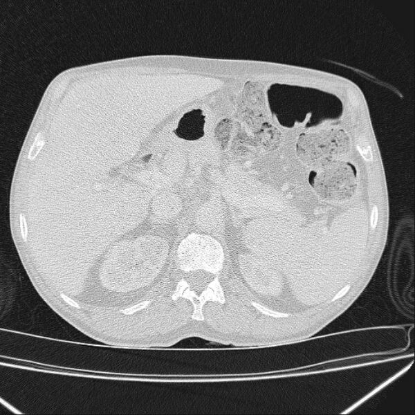 File:Azygos lobe (Radiopaedia 38259-40275 Axial lung window 87).jpg