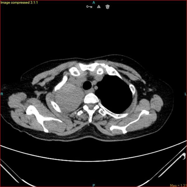 File:Azygos vein aneurysm (Radiopaedia 77824-90130 A 12).jpg