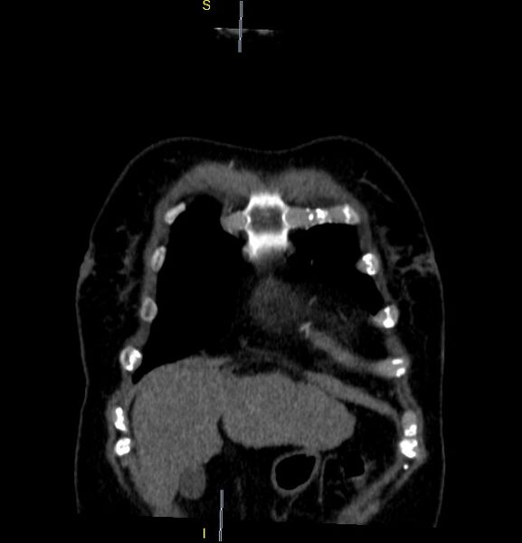 File:Azygos vein aneurysm (Radiopaedia 77824-90130 C 4).JPG