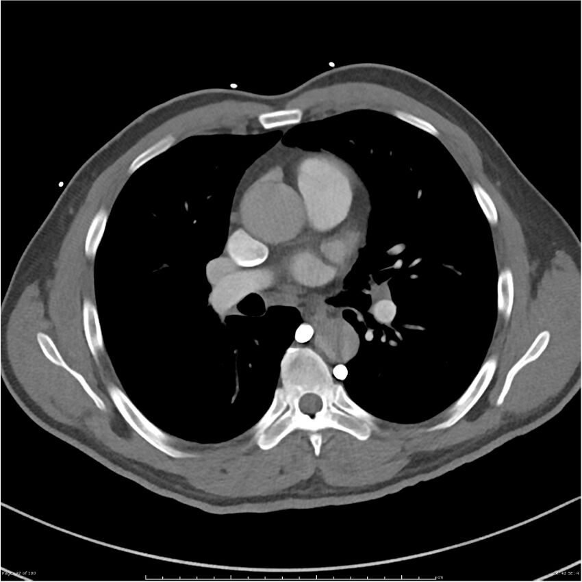 Azygos venous system anatomy (CT pulmonary angiography) (Radiopaedia 25928-26077 Axial C+ CTPA 42).jpg