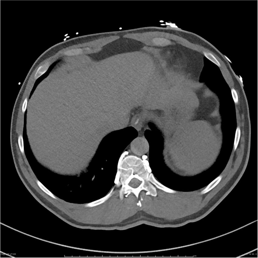 Azygos venous system anatomy (CT pulmonary angiography) (Radiopaedia 25928-26077 Axial C+ CTPA 76).jpg