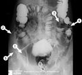 Barium enema (anatomy quiz) (Radiopaedia 60345).jpg