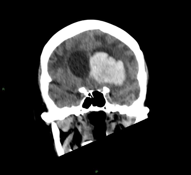 File:Basal ganglia hemorrhage (Radiopaedia 58766-65988 Coronal non-contrast 44).jpg