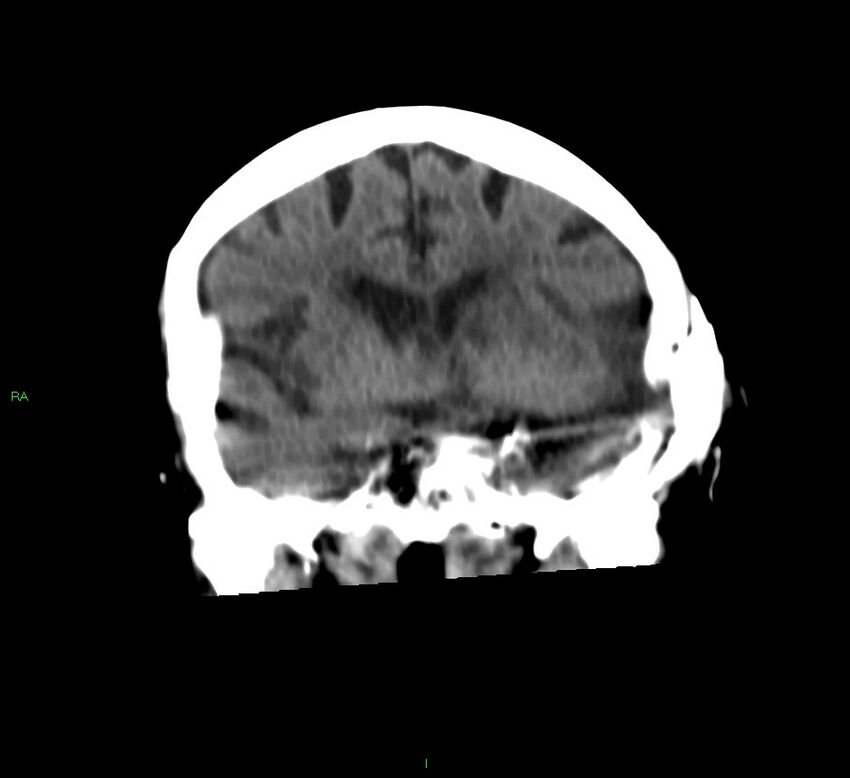 Basal ganglia hemorrhage (Radiopaedia 58790-66024 Coronal non-contrast 37).jpg