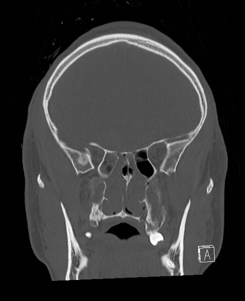 File:Base of skull fracture with bilateral Le Fort fractures (Radiopaedia 47094-51638 Coronal bone window 66).jpg