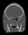 Base of skull fracture with bilateral Le Fort fractures (Radiopaedia 47094-51638 Coronal bone window 66).jpg