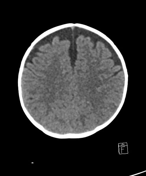 File:Benign enlargement of subarachnoid spaces in infancy (BESS) (Radiopaedia 87459-103795 Axial non-contrast 29).jpg