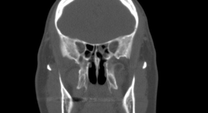File:Benign mixed salivary tumor of the parotid gland (Radiopaedia 35261-36792 Coronal bone window 10).jpg