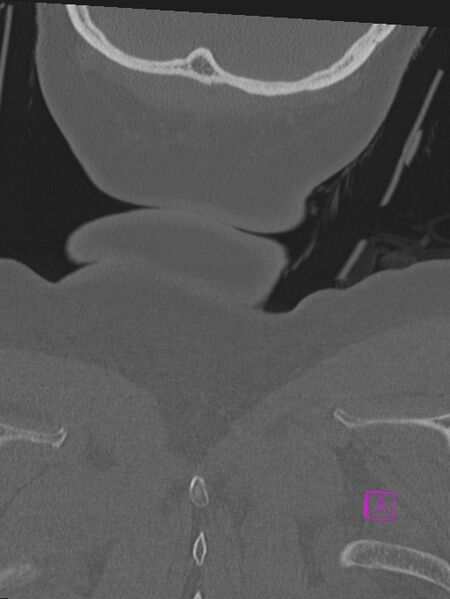 File:Bilateral atlanto-occipital assimilation (Radiopaedia 28350-28603 Coronal bone window 57).jpg