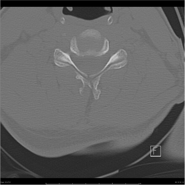 File:Bilateral cervical ribs (Radiopaedia 25868-26017 Axial bone window 29).jpg