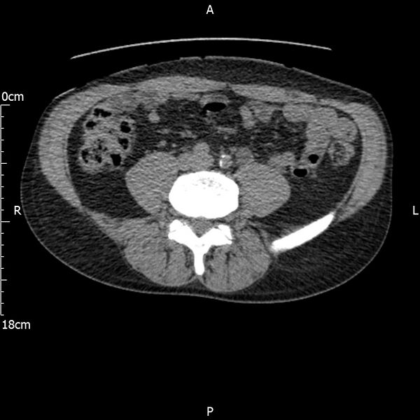 File:Bilateral medullary nephrocalcinosis with ureteric calculi (Radiopaedia 71269-81569 Axial non-contrast 80).jpg