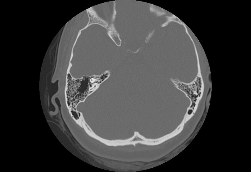 Bilateral otospongiosis (Radiopaedia 35447-36940 B 42).jpg