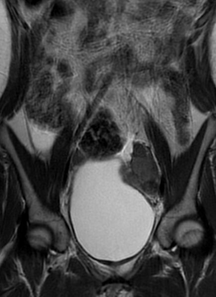 File:Bilateral ovarian fibrothecomas - adolescent (Radiopaedia 86604-102707 Coronal T2 14).jpg