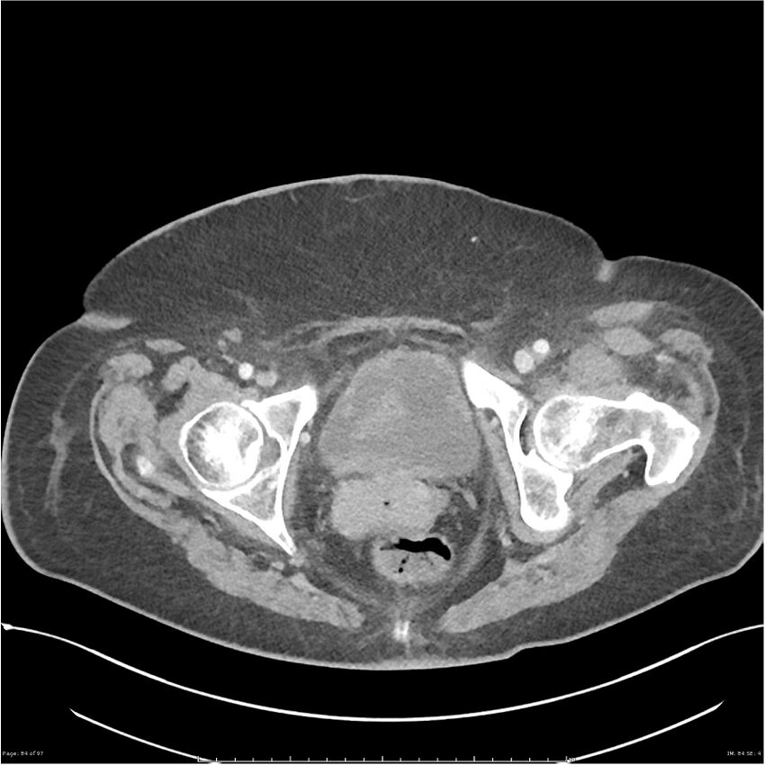 Bilateral psoas hematomas (Radiopaedia 24057-24279 A 84).jpg
