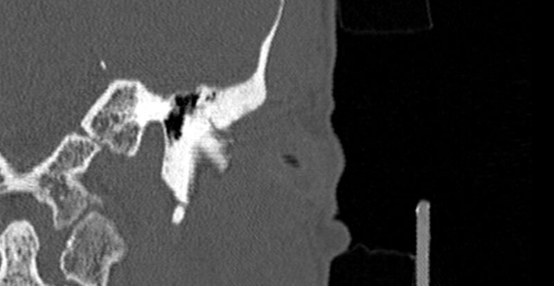 File:Bilateral temporal bone fractures (Radiopaedia 29482-29970 B 9).jpg