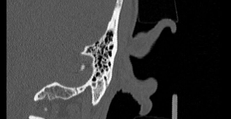 File:Bilateral temporal bone fractures (Radiopaedia 29482-29970 B 96).jpg