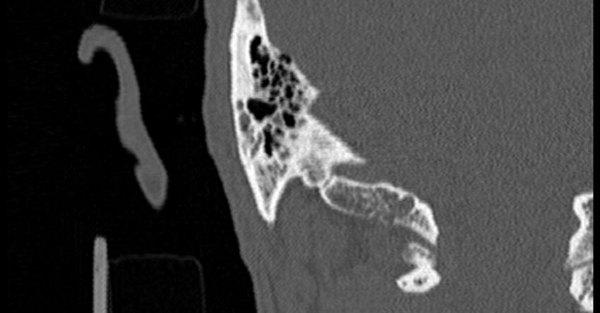 Bilateral temporal bone fractures (Radiopaedia 29482-29970 Coronal non-contrast 163).jpg