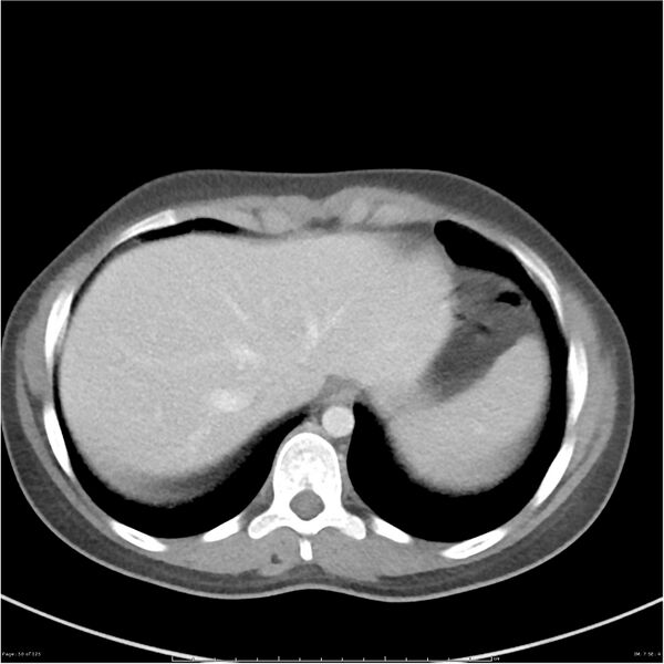 File:Bilateral ureteritis and cystitis (Radiopaedia 25340-25594 A 7).jpg