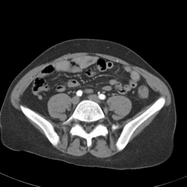 File:Biliary necrosis - liver transplant (Radiopaedia 21876-21845 A 47).jpg