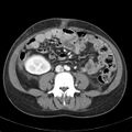 Biliary necrosis - liver transplant (Radiopaedia 21876-21846 B 45).jpg