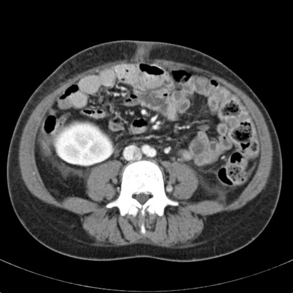 File:Biliary necrosis - liver transplant (Radiopaedia 21876-21846 B 45).jpg