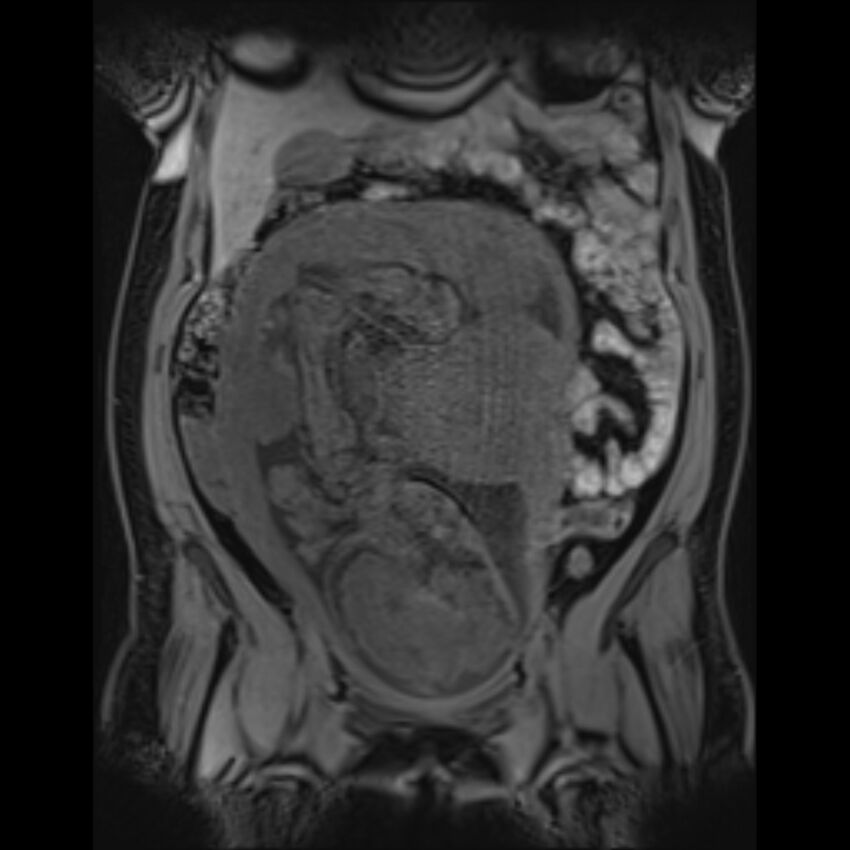 Bilobed placenta accreta (Radiopaedia 69648-79591 Coronal T1 vibe 75).jpg
