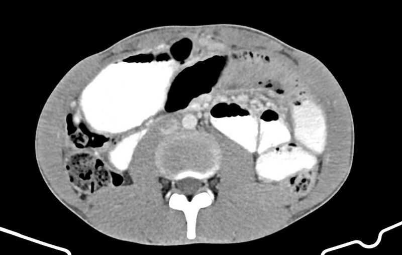 File:Blunt injury to the small bowel (Radiopaedia 74953-85987 A 89).jpg