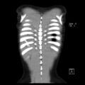 Bochdalek diaphragmatic hernia (Radiopaedia 38866-41059 Coronal liver window 20).jpg