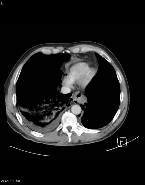 File:Boerhaave syndrome with tension pneumothorax (Radiopaedia 56794-63603 A 3).jpg