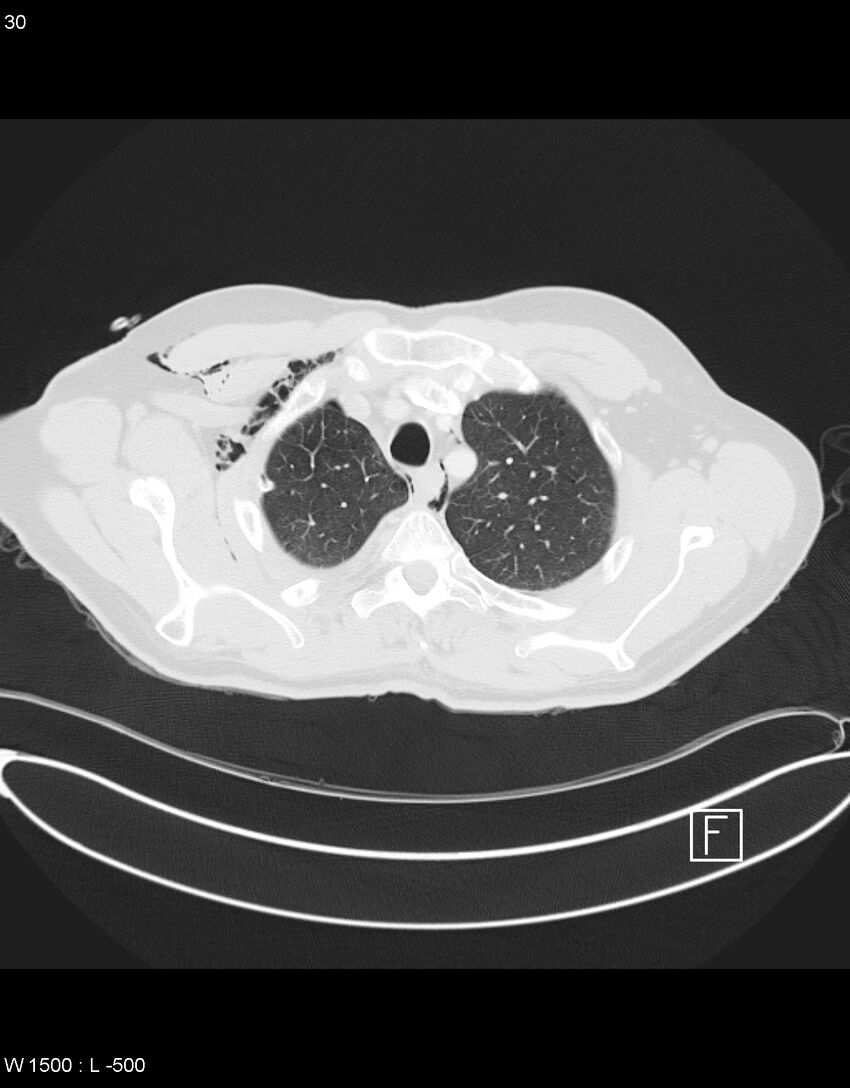 Boerhaave syndrome with tension pneumothorax (Radiopaedia 56794-63605 Axial lung window 14).jpg