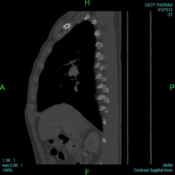 File:Bone metastases from lung carcinoma (Radiopaedia 54703-60937 Sagittal bone window 28).jpg