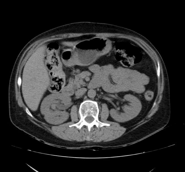 File:Bosniak renal cyst - type IV (Radiopaedia 22929-22953 Axial non-contrast 21).jpg