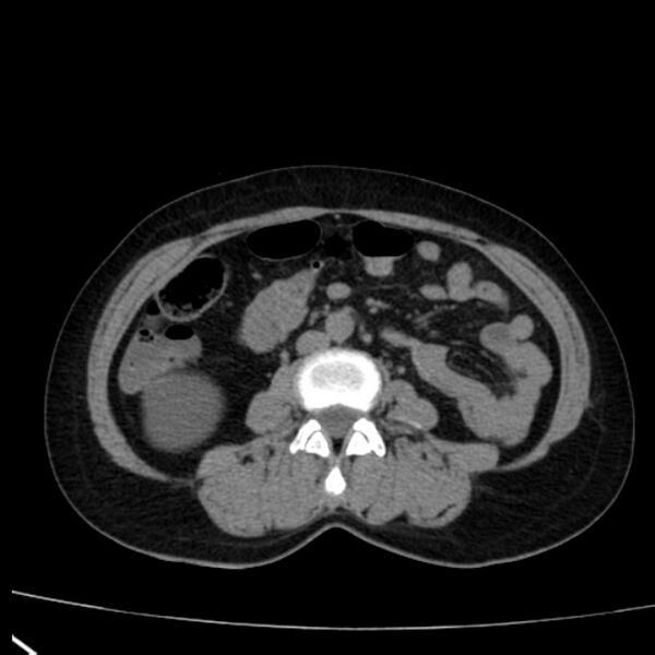 File:Bosniak renal cyst - type I (Radiopaedia 27479-27675 Axial non-contrast 50).jpg