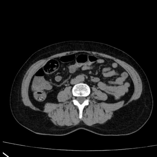 File:Bosniak renal cyst - type I (Radiopaedia 27479-27675 Axial non-contrast 55).jpg