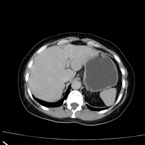 File:Bosniak renal cyst - type I (Radiopaedia 27479-27675 D 1).jpg