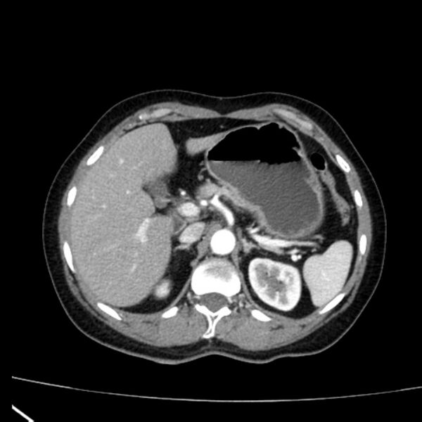 File:Bosniak renal cyst - type I (Radiopaedia 27479-27675 renal cortical phase 20).jpg