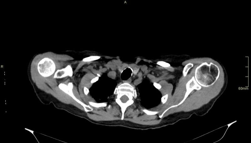 File:Brachial artery foreign body (Radiopaedia 54583-60820 Axial non-contrast 12).jpg