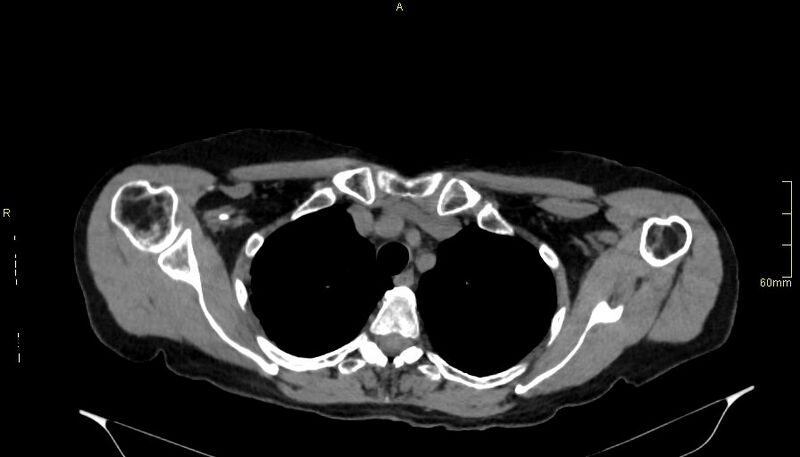 File:Brachial artery foreign body (Radiopaedia 54583-60820 Axial non-contrast 18).jpg