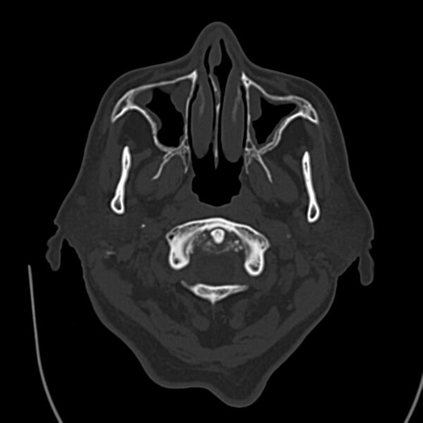 File:Brain Pantopaque remnants (Radiopaedia 78403-91048 Axial bone window 10).jpg