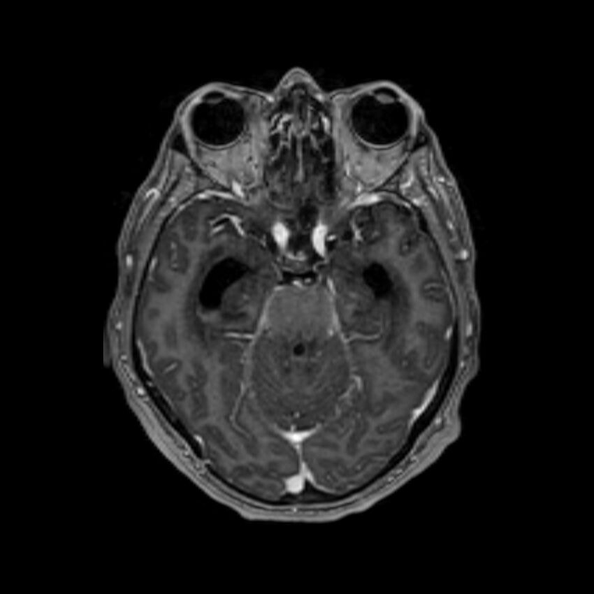 Brain abscess complicated by intraventricular rupture and ventriculitis (Radiopaedia 82434-96577 Axial T1 C+ 22).jpg