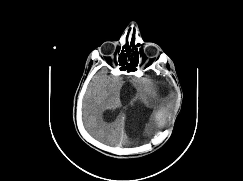 Brain injury by firearm projectile (Radiopaedia 82068-96088 A 125).jpg