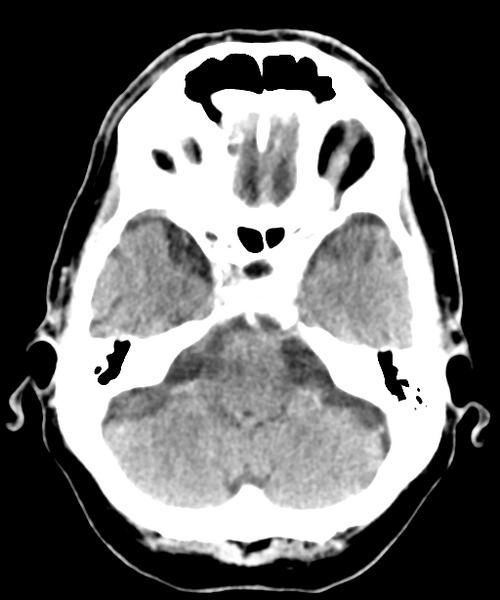 File:Brain metastasis (lung cancer) (Radiopaedia 48289-53177 Axial C+ 6).png